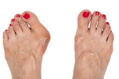 摘要：一位老年妇女患有严重的假肢畸形，她的脚上的近视和俯视使她的大脚趾弯曲和扭曲，并与白色背景隔离.