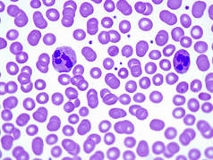 淋巴白血病患者血液涂片中的两个分割的中性粒细胞。1000x放大率