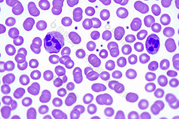 淋巴白血病患者血液涂片中的两个分割的中性粒细胞。1000x放大率