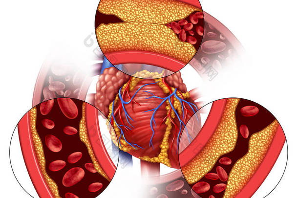 心脏动脉疾病和冠心病的医学概念，即逐渐形成斑块，导致动脉阻塞和动脉粥样硬化，是具有<strong>三维</strong>示踪<strong>元素</strong>的人体解剖学.