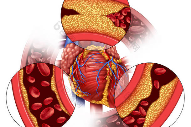 心脏动脉疾病和冠心病的医学概念，即逐渐形成斑块，导致动脉阻塞和动脉粥样硬化，是具有三维示踪元素的人体解剖学.