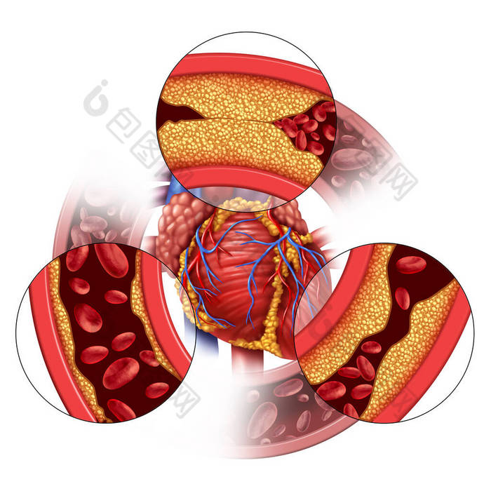 心脏动脉疾病和冠心病的医学概念，即逐渐形成斑块，导致动脉阻塞和动脉粥样硬化，是具有三维示踪元素的人体解剖学.
