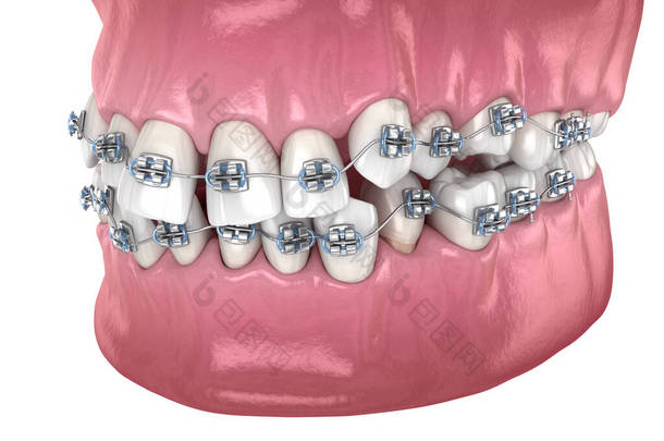 牙齿位置不正常,用金属<strong>矫形器</strong>矫正错误.医学上准确的牙科3D图像