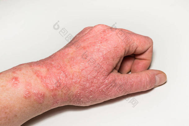 手部皮肤过敏性病变，有裂缝、发炎和剥皮。银屑病，特应性皮炎，湿疹。皮肤问题