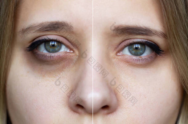 用化妆品把年轻女性的脸剪下来的照片女性绿色眼睛，在化妆品治疗前后眼睛下方有瘀伤。黑眼圈下