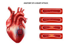 心脏病发解剖的医学说明