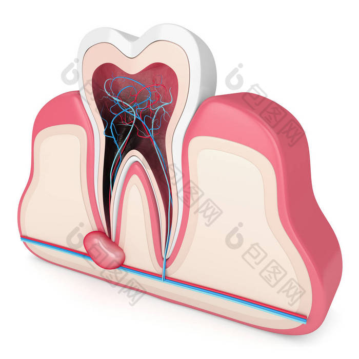 带囊肿的牙龈内的3D牙体