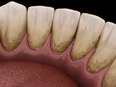 焦油和杆菌牙菌斑，下颌骨。医学上准确的人类牙齿治疗三维图像