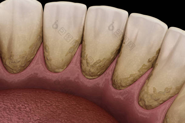 焦油和杆菌牙菌斑，下颌骨。医学上准确的人类<strong>牙齿</strong>治疗三维图像