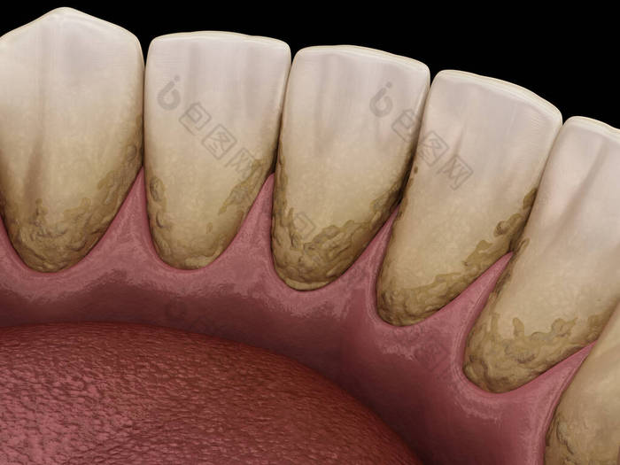 焦油和杆菌牙菌斑，下颌骨。医学上准确的人类牙齿治疗三维图像