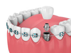 3d. 用正畸牙套和牙科植入物进行牙齿渲染。正畸大括号概念