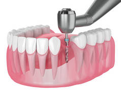 牙龈钻孔下颌骨3D成形术