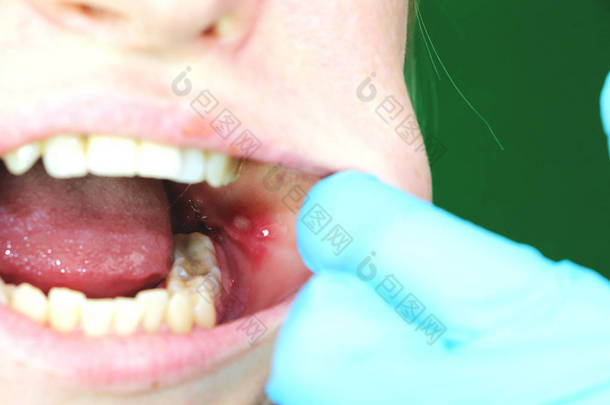 疼痛的溃疡和口炎在一个女孩的粘液脸颊上。手术后取出智齿。缝合和术后时间