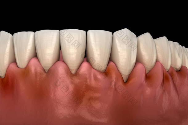 牙龈炎,牙龈发炎.医学上准确的3D图像