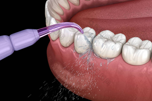 灌溉器，水牙清洁。口腔卫生的医学上准确的三维插图.