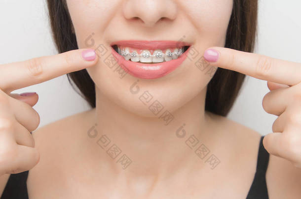 快乐女人嘴上的牙托，在美白后，用两根手指在牙齿的括号上显示出来。带有金属领带和灰色弹力或橡皮筋的自联括号，以获得完美的微笑。牙齿矫正治疗