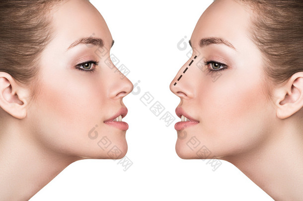 鼻子整形手术前、 后的女人