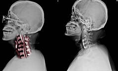 x 线 c-spine 显示 sp 内固定 c4-c5 & c6, 并在 c4 至 c6 水平的脊髓有超信号强度病变.