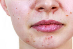 女性面部痤疮皮肤问题