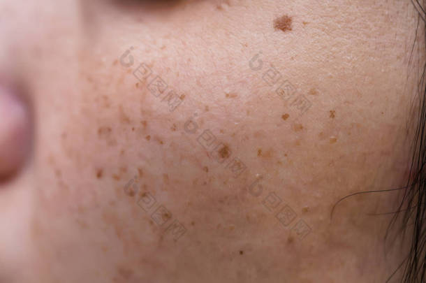 女人有问题的皮肤，痤疮疤痕，油腻的皮肤和毛孔，黑斑和脸上的黑头和白发