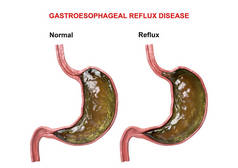 胃食管反流病 - 导致胃酸进入食道的消化机制（括约肌）的失败