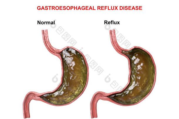 胃食管反流病 - 导致<strong>胃酸</strong>进入食道的消化机制（括约肌）的失败