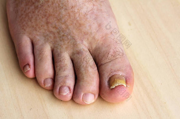 趾甲和皮肤斑点上的指甲真菌的病理学变化