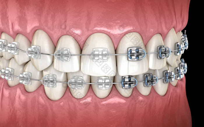 牙齿与金属和透明牙套在牙龈。医学上准确的牙科 3D 插图