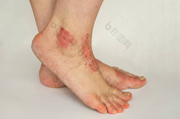 在白色背景下对患有慢性银屑病的妇女的腿进行包扎。包扎皮疹并在病人的皮肤上涂上鳞片。皮肤科的问题。皮肤干透了被隔离了
