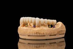 在黑色玻璃背景下的下颌骨假牙的特写侧视图。人造下颚，有镶边和冠冕。植入物的牙齿恢复。牙科学概念照片.