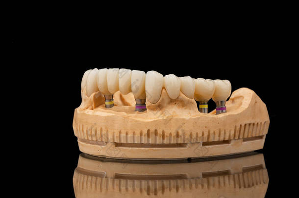 在黑色玻璃背景下的<strong>下颌骨</strong>假牙的特写侧视图。人造下颚，有镶边和冠冕。植入物的牙齿恢复。牙科学概念照片.