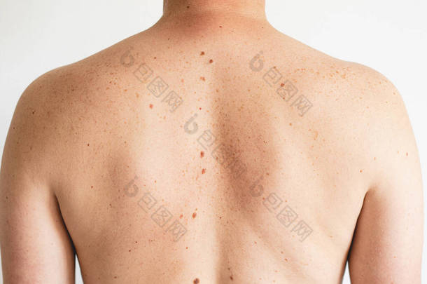 色素沉着一个背带着小痣和雀斑的男人裸露皮肤的特写。检查良性痣。皮肤上的胎记