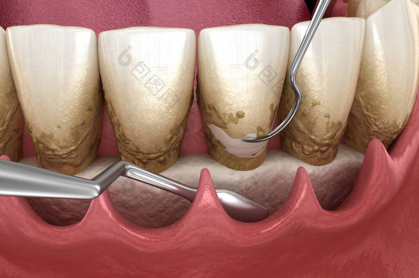 开切：鳞片和根部修整（传统的牙周病治疗） 。医学上准确的人类<strong>牙齿</strong>治疗三维图像