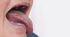 患有疾病和舌头红肿的女人。牙周炎和牙龈炎的概念，复制空间，乳腺炎，白内障