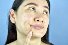 亚洲女性手指点在白头痤疮在下巴上, 成人担心面部皮肤问题, 皱纹, 大毛孔, 干燥皮肤, 痤疮疤痕, 皮肤老化的迹象.