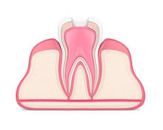 3d. 用根管治疗法在牙龈上的牙齿呈现白色