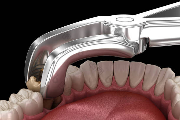 龋伤磨牙的拔牙.医学上准确的牙齿3D图像.