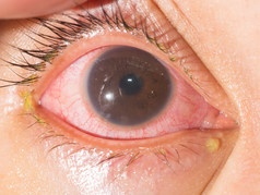 急性前葡萄膜炎在眼试验