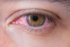 结膜炎红眼睛的宏.