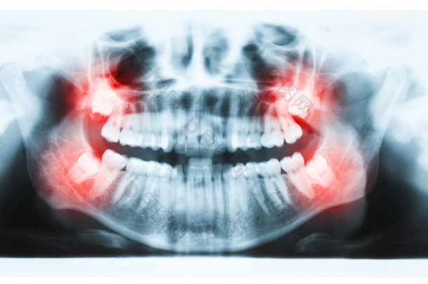 全景 x 射线图像的牙齿和口腔与所有四个<strong>磨牙</strong> ve