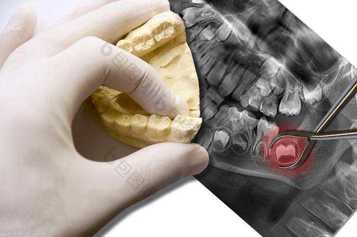 手显示臼齿和牙痛智齿