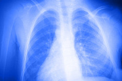 肺部的 x 光照片