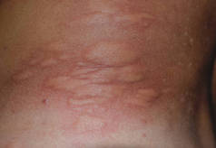 过敏皮肤背部和两侧。皮肤红肿红肿的过敏反应