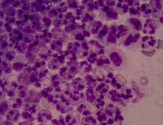 人类显示异常细胞癌细胞.