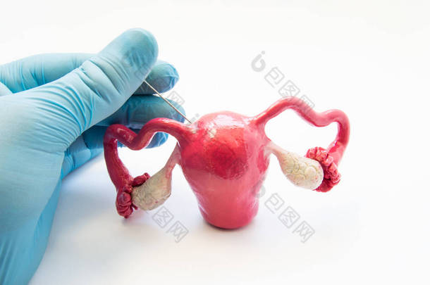 妇科手术活检的概念照片女性生殖器官和组织-<strong>子宫</strong>, <strong>子宫</strong>内膜或卵巢。医生在手套进行活检手术穿刺<strong>子宫</strong>