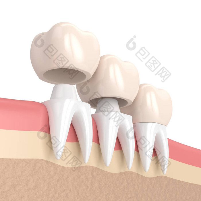 3d. 更换牙冠的补牙