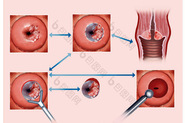 说明宫颈灼烧的过程.