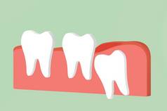 智齿 (角或内侧嵌塞) 与炎症对其他牙齿的影响-牙科卡通3d 渲染平面风格设计的可爱字符