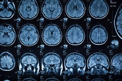 人脑的医学 x 射线, 特写图像