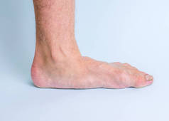 有关节疾病和扁平脚症状的人的左腿。腿部和关节疾病.